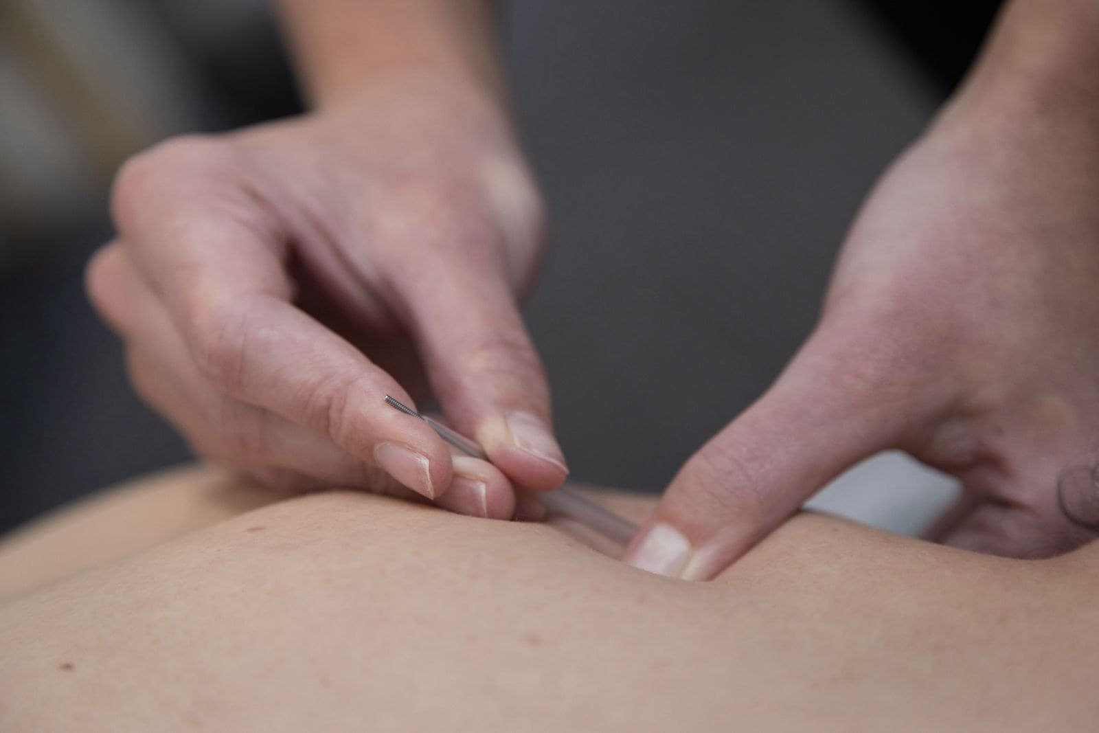Physiotherapist performing dry needling on a patient