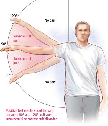 shoulder pain, arc of pain, rotator cuff tendinopathy, shoulder pain, bursitis, subacromial pain, rotator cuff tear, shoulder pop