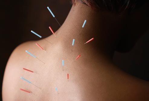 acupuncture treatment, acupuncture, dry needling fremantle