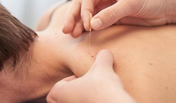 dry needling, dry needling fremantle, dry needling vs acupuncture