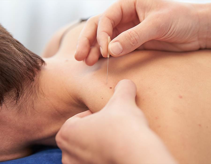 dry needling, dry needling fremantle, dry needling vs acupuncture, physiotherapy fremantle