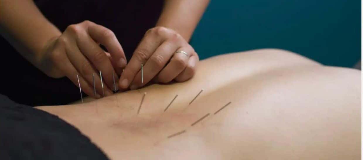 Back being Dry Needled | Dry Needling Beeliar, East Fremantle and Booragoon